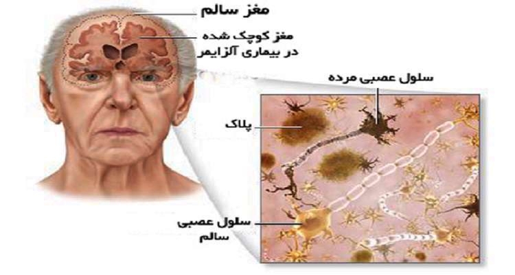 علت آلزایمر