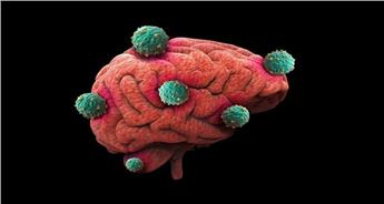 علائم تومور مغزی چیست؟ تشخیص و درمان انواع 